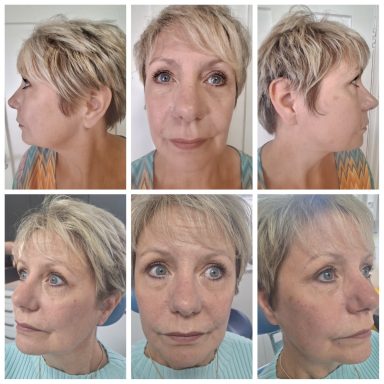 Cheek, Jaw and Chin contouring using Juvederm Dermal Filler