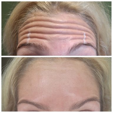 Before and after Botox treating forehead lines