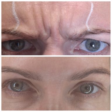 Before and after Botox treating Glabellar/frown lines