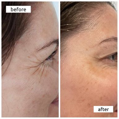 Before and after Botox treating Crows Feet