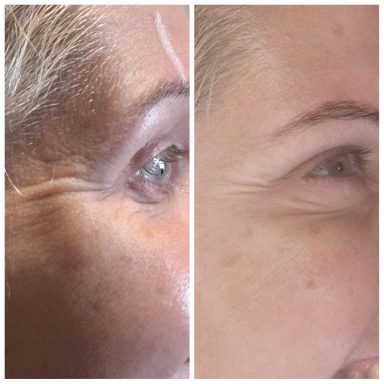 Before and after Botox treating Crows Feet