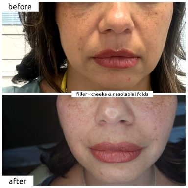 Before and after dermal filler (cheeks and nasolabial folds)