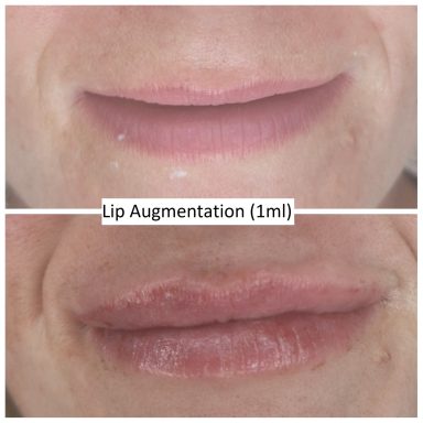 Before and after lip filler 1ml