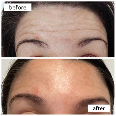 Before and after Botox treating forehead lines