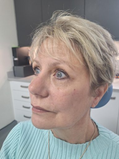 Cheek, Jaw and Chin contouring using Juvederm Dermal Filler