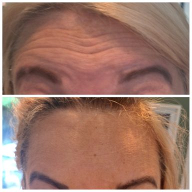 Before and after Botox treating forehead lines