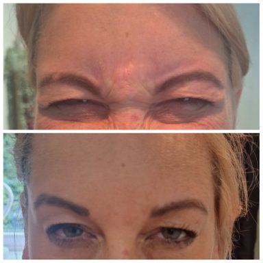 Before and after Botox treating Glabellar/frown lines