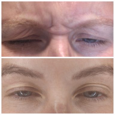 Before and after Botox treating Glabellar/frown lines