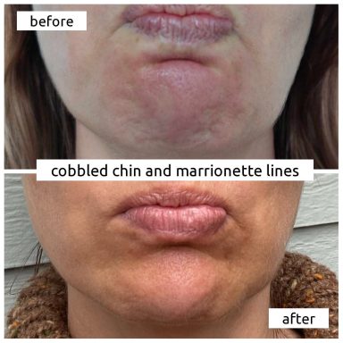 Before and after Botox treating cobbled chin and marionette lines