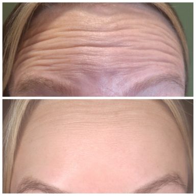 Before and after Botox treating forehead lines