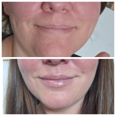 Juvederm subtle lip filler 0.5ml