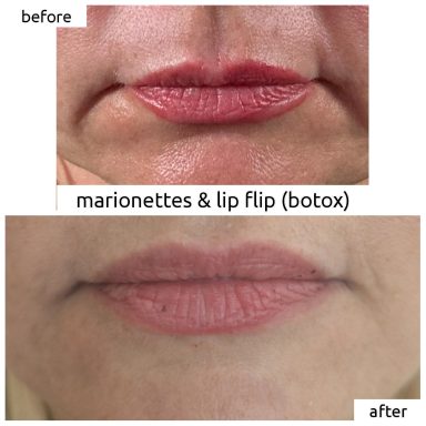 Before and after Botox for marionette lines and lip flip