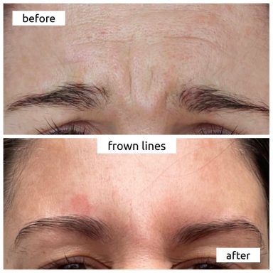 Before and after Botox treating Glabellar/frown lines