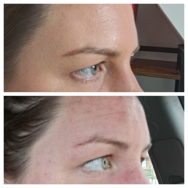 Before and after Botox treating crows feet