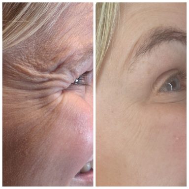 Before and after Botox treating Crows Feet